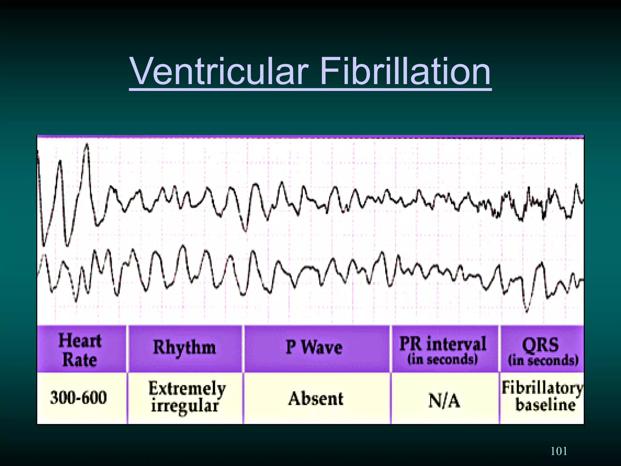 101
Ventricular Fibrillation
 