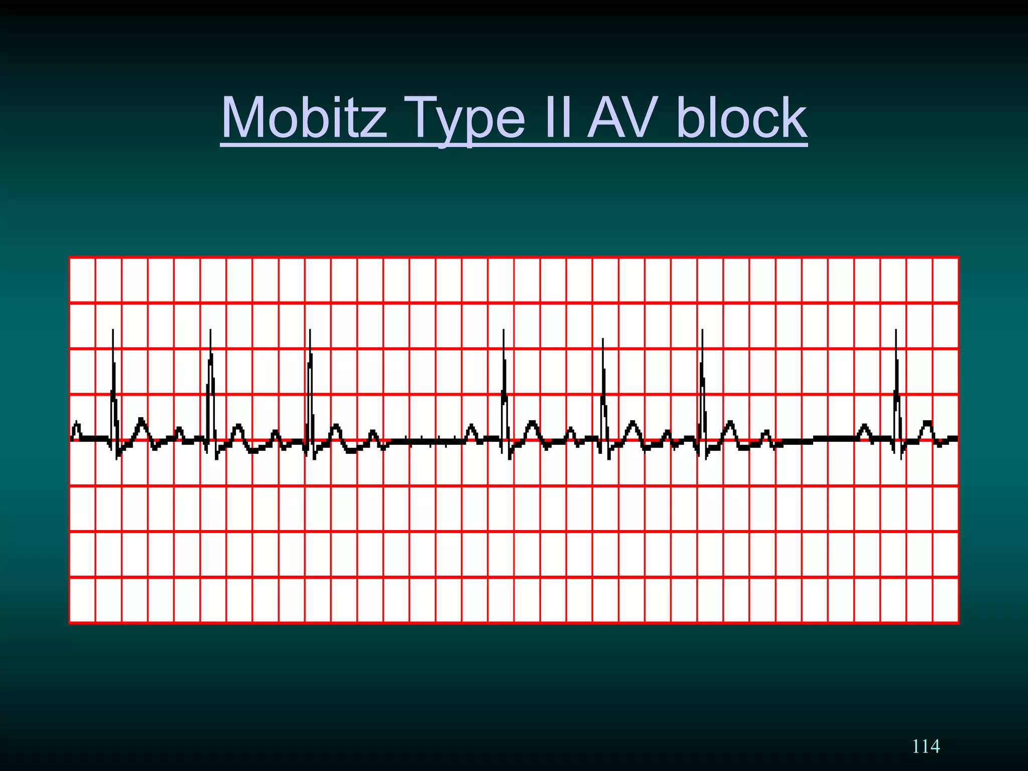 114
Mobitz Type II AV block
 
