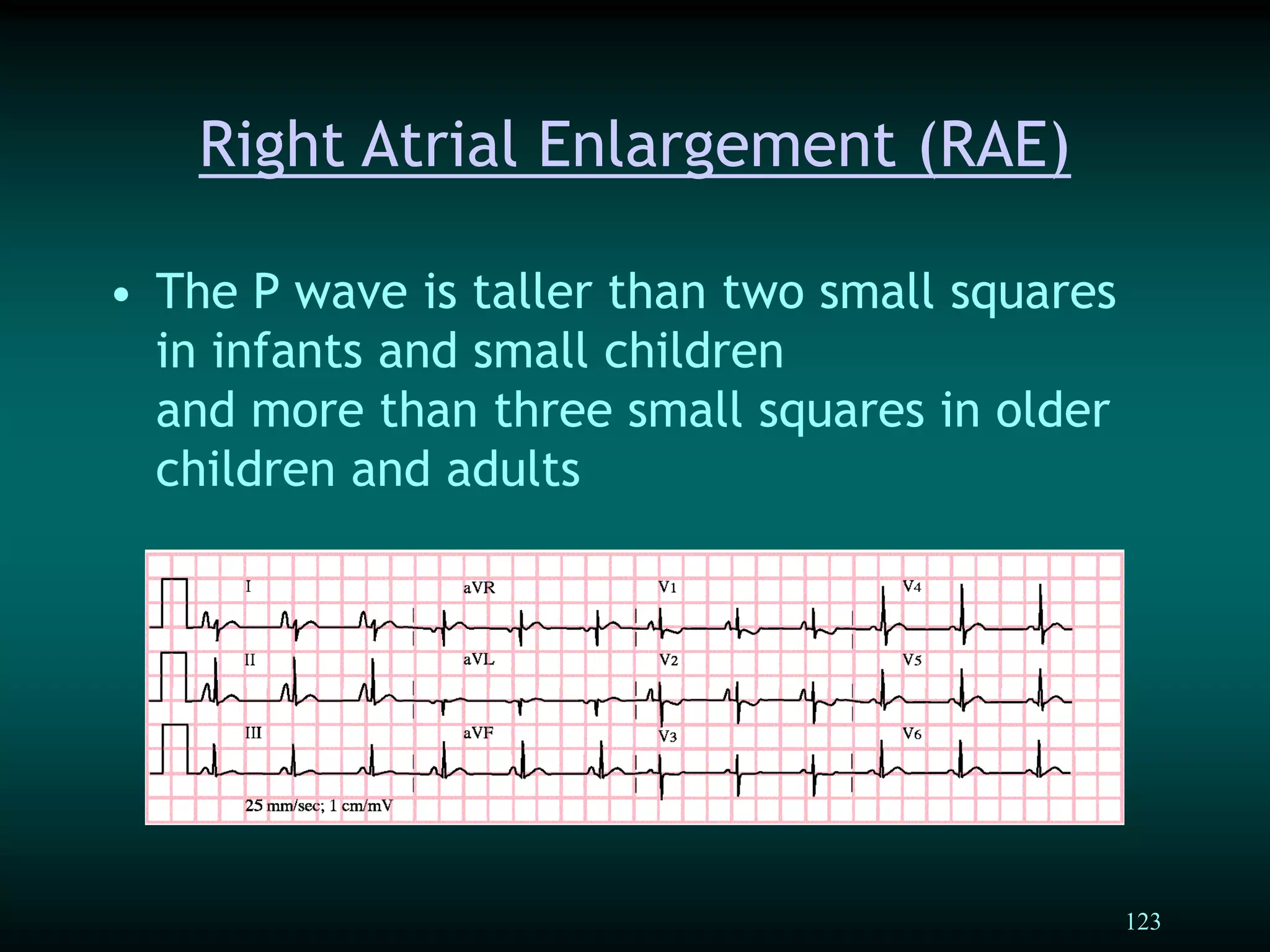 123
Right Atrial Enlargement (RAE)
• The P wave is taller than two small squares
in infants and small children
and more than three small squares in older
children and adults
 