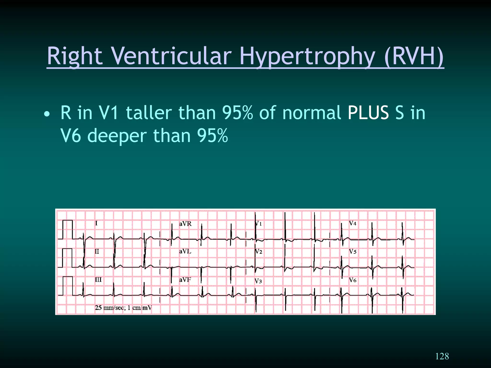 128
Right Ventricular Hypertrophy (RVH)
• R in V1 taller than 95% of normal PLUS S in
V6 deeper than 95%
 