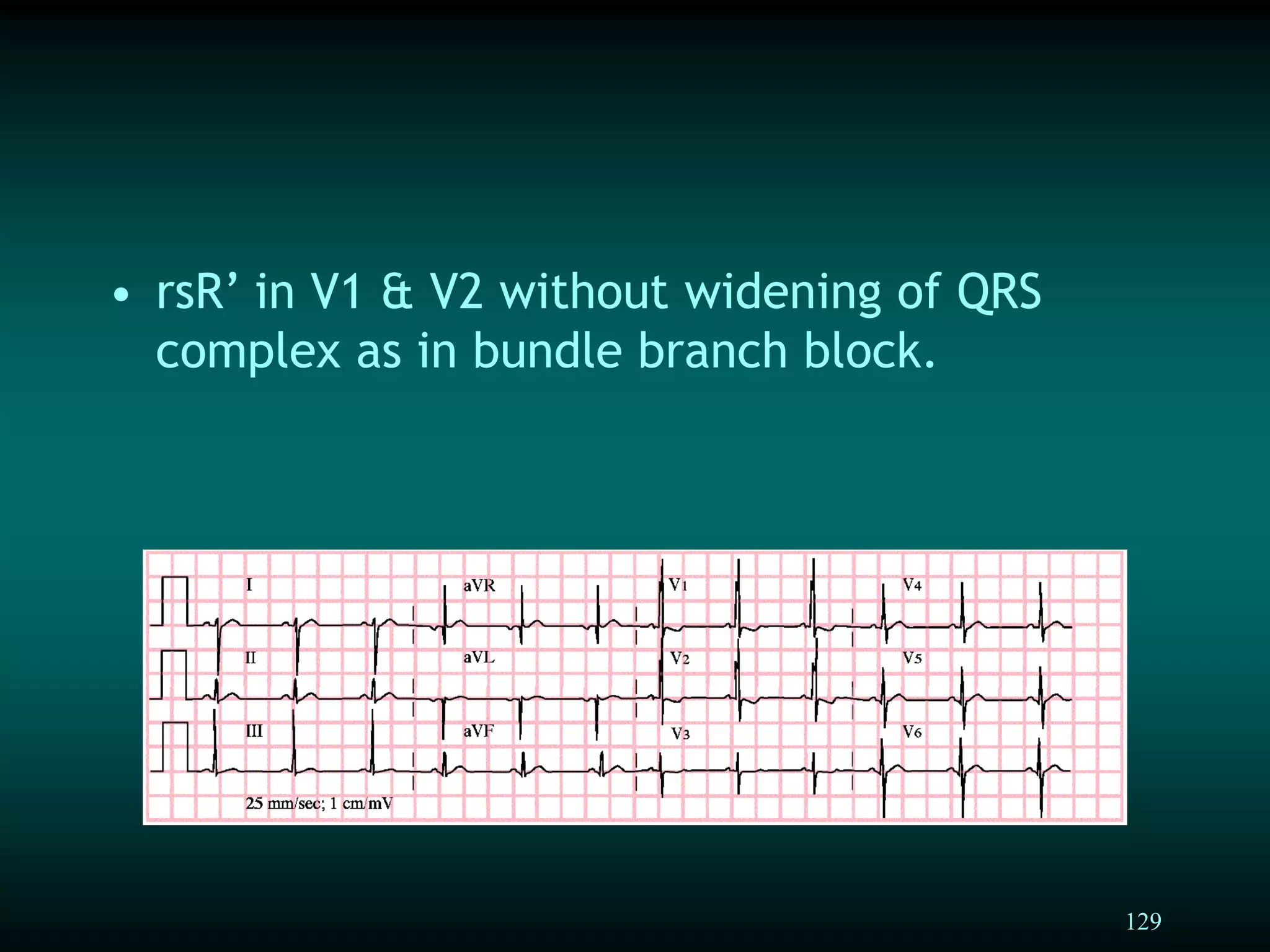 129
• rsR’ in V1 & V2 without widening of QRS
complex as in bundle branch block.
 