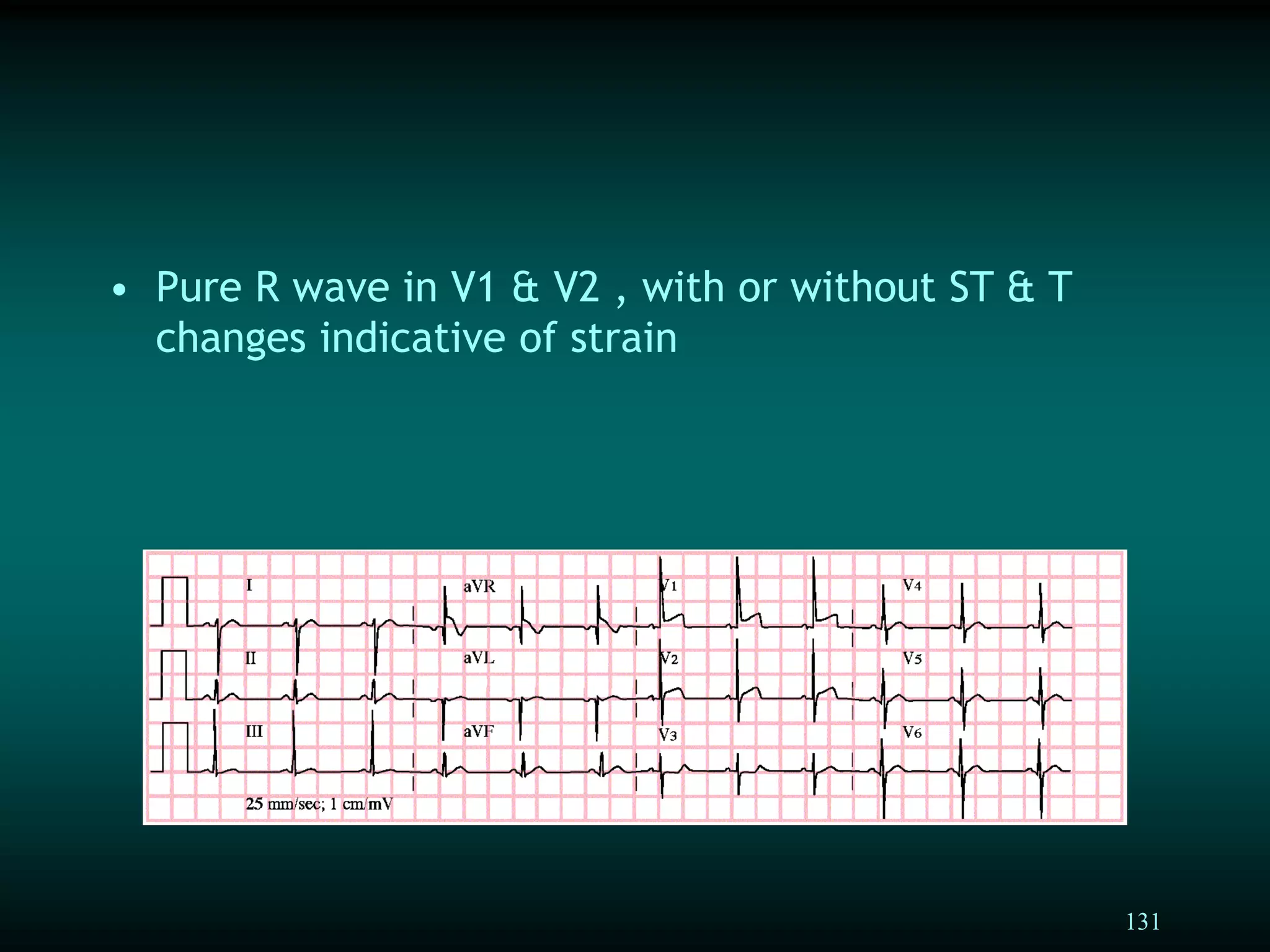 131
• Pure R wave in V1 & V2 , with or without ST & T
changes indicative of strain
 