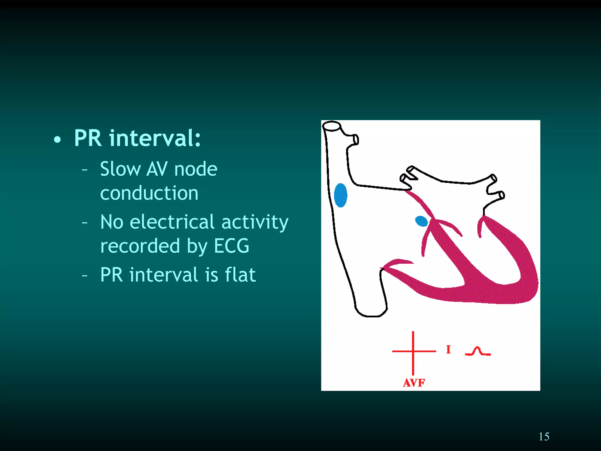 15
• PR interval:
– Slow AV node
conduction
– No electrical activity
recorded by ECG
– PR interval is flat
 