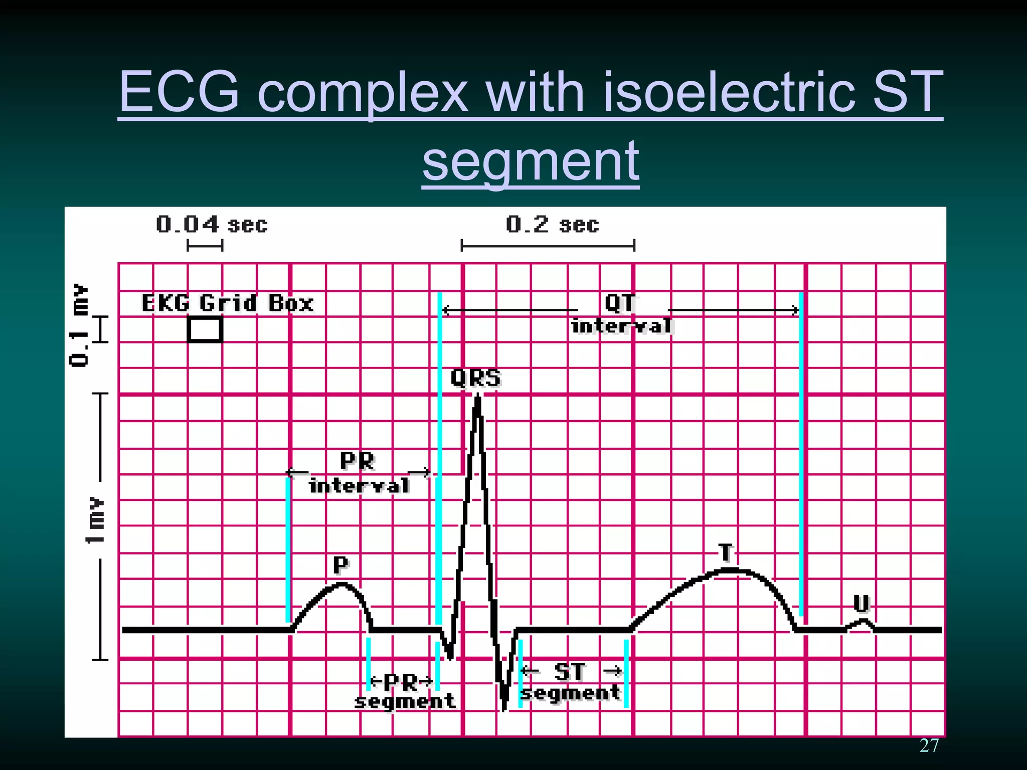 27
ECG complex with isoelectric ST
segment
 