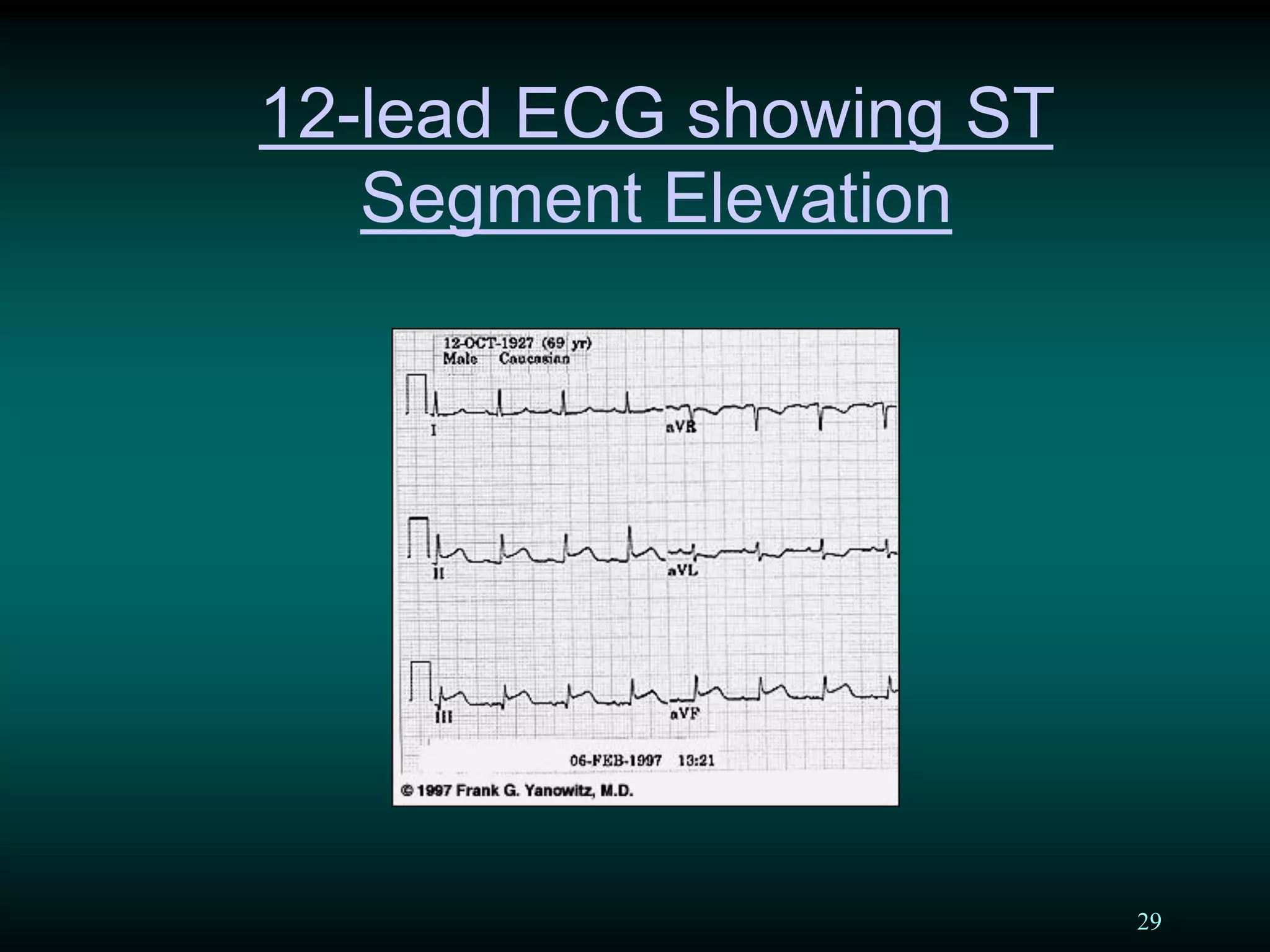 29
12-lead ECG showing ST
Segment Elevation
 