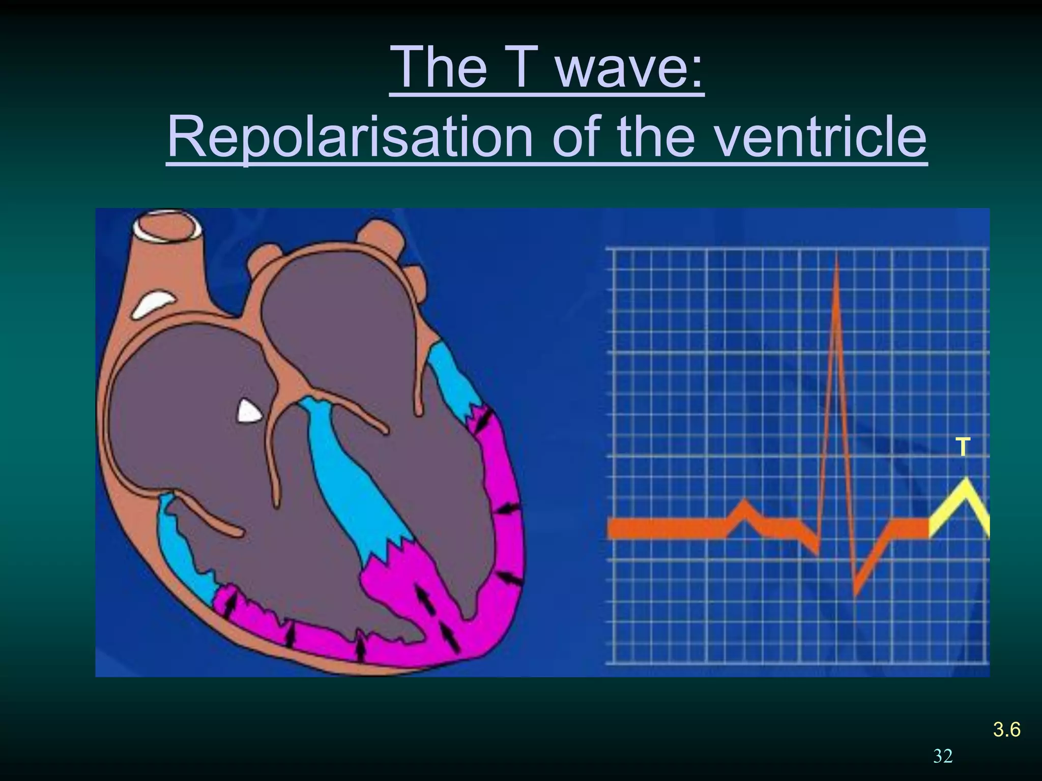 32
Repolarisation of Ventricle
The T wave:
Repolarisation of the ventricle
T
3.6
 