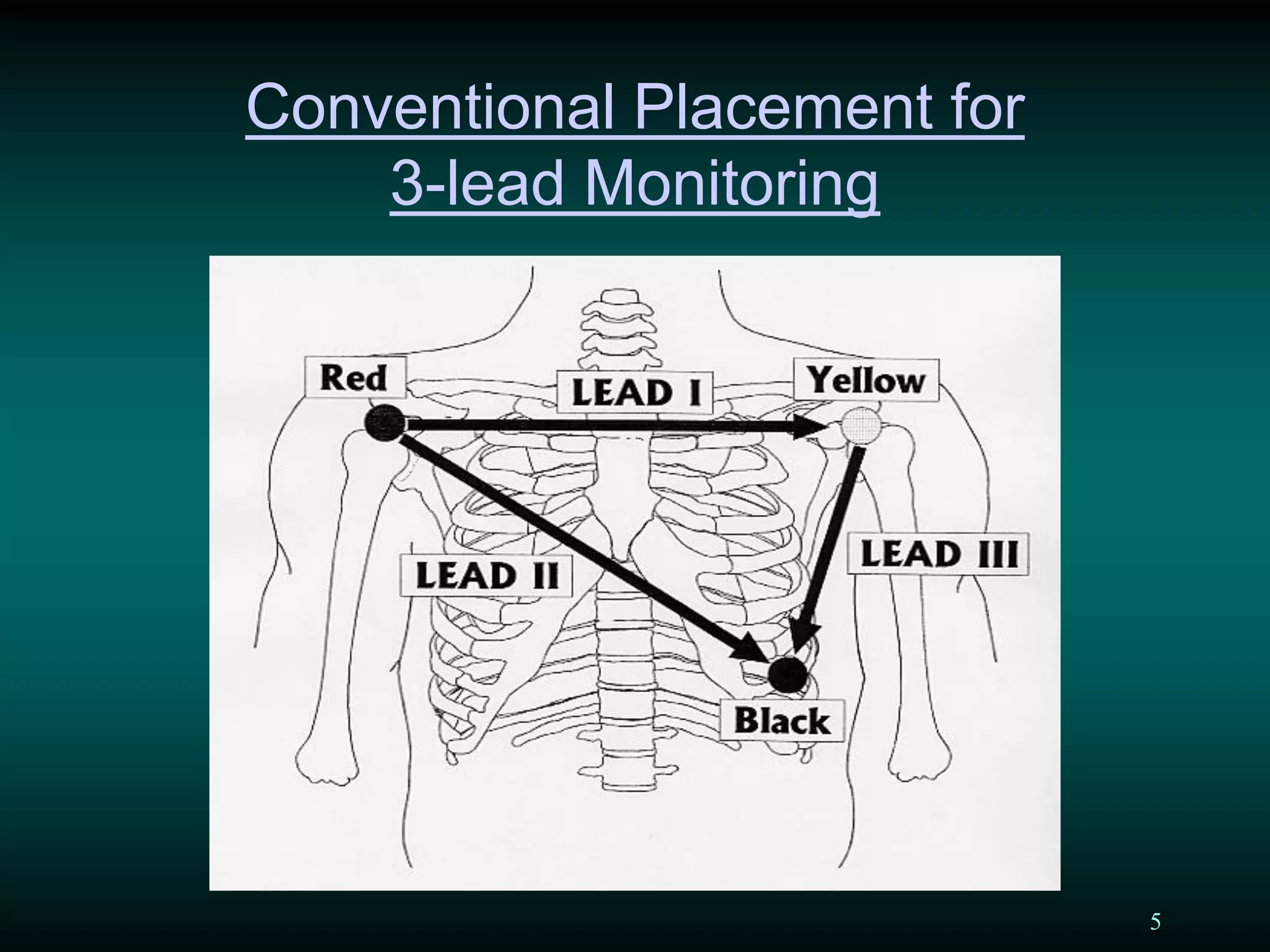 5
Conventional Placement for
3-lead Monitoring
 