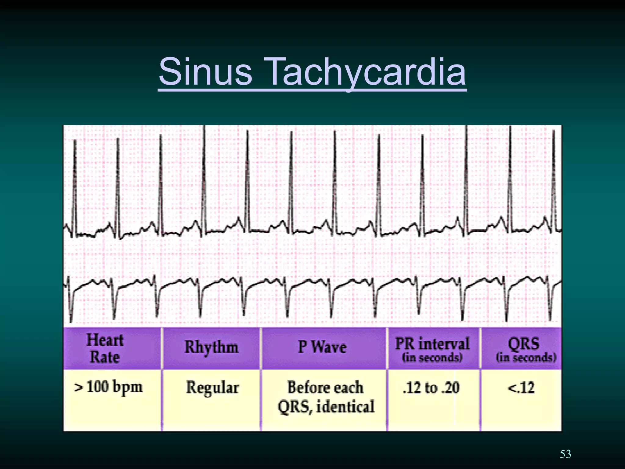53
Sinus Tachycardia
 