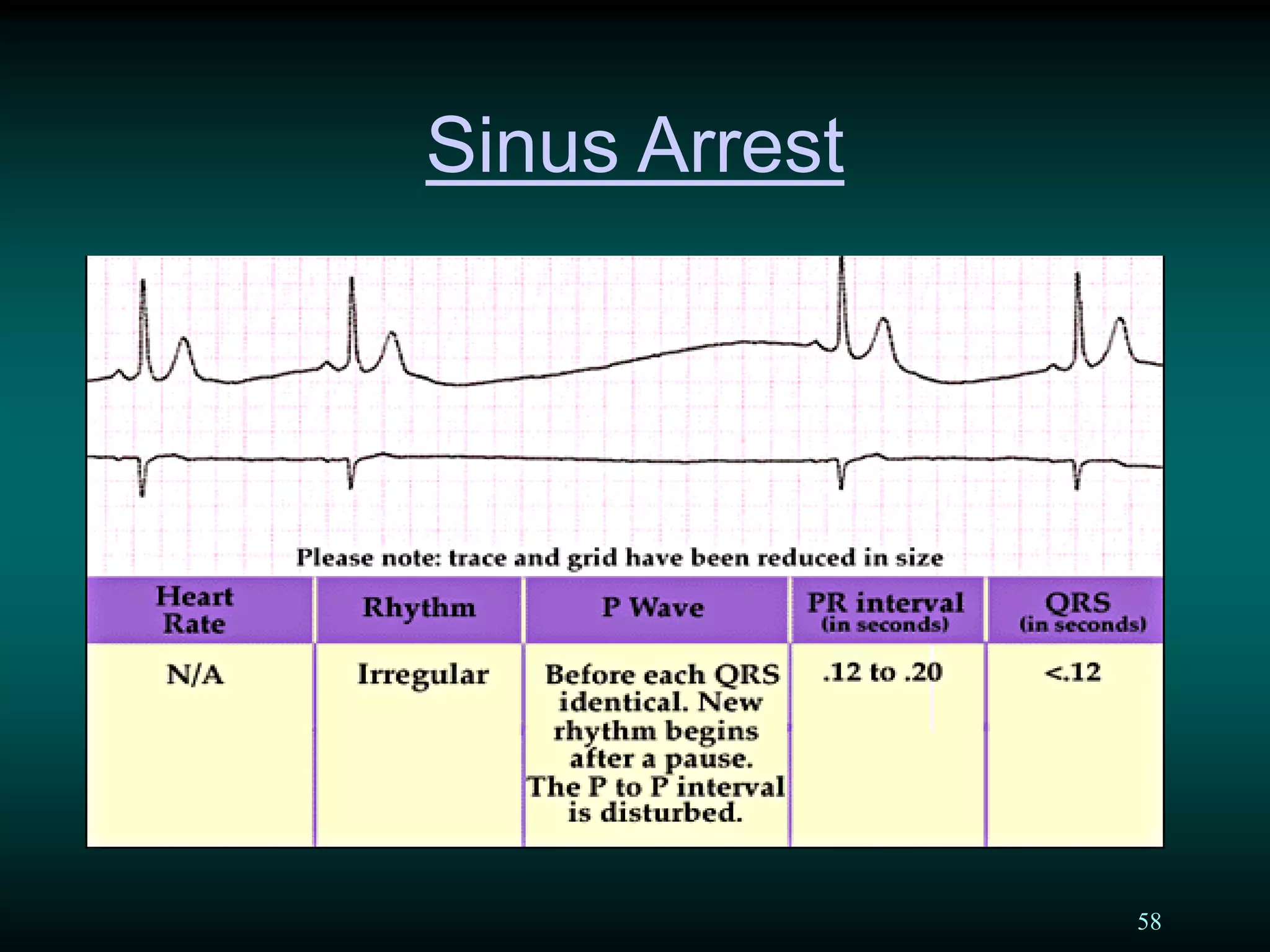 58
Sinus Arrest
 