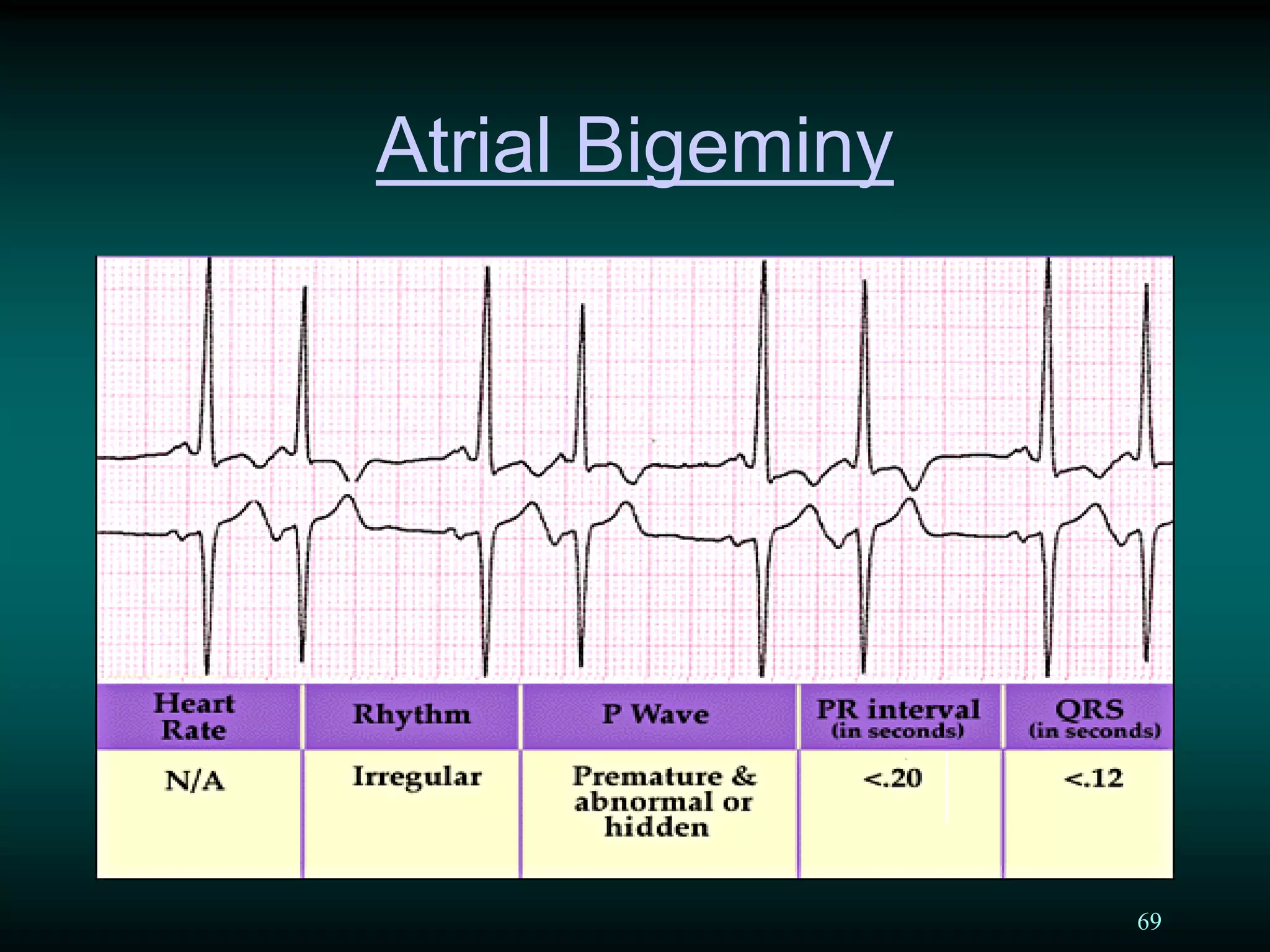 69
Atrial Bigeminy
 
