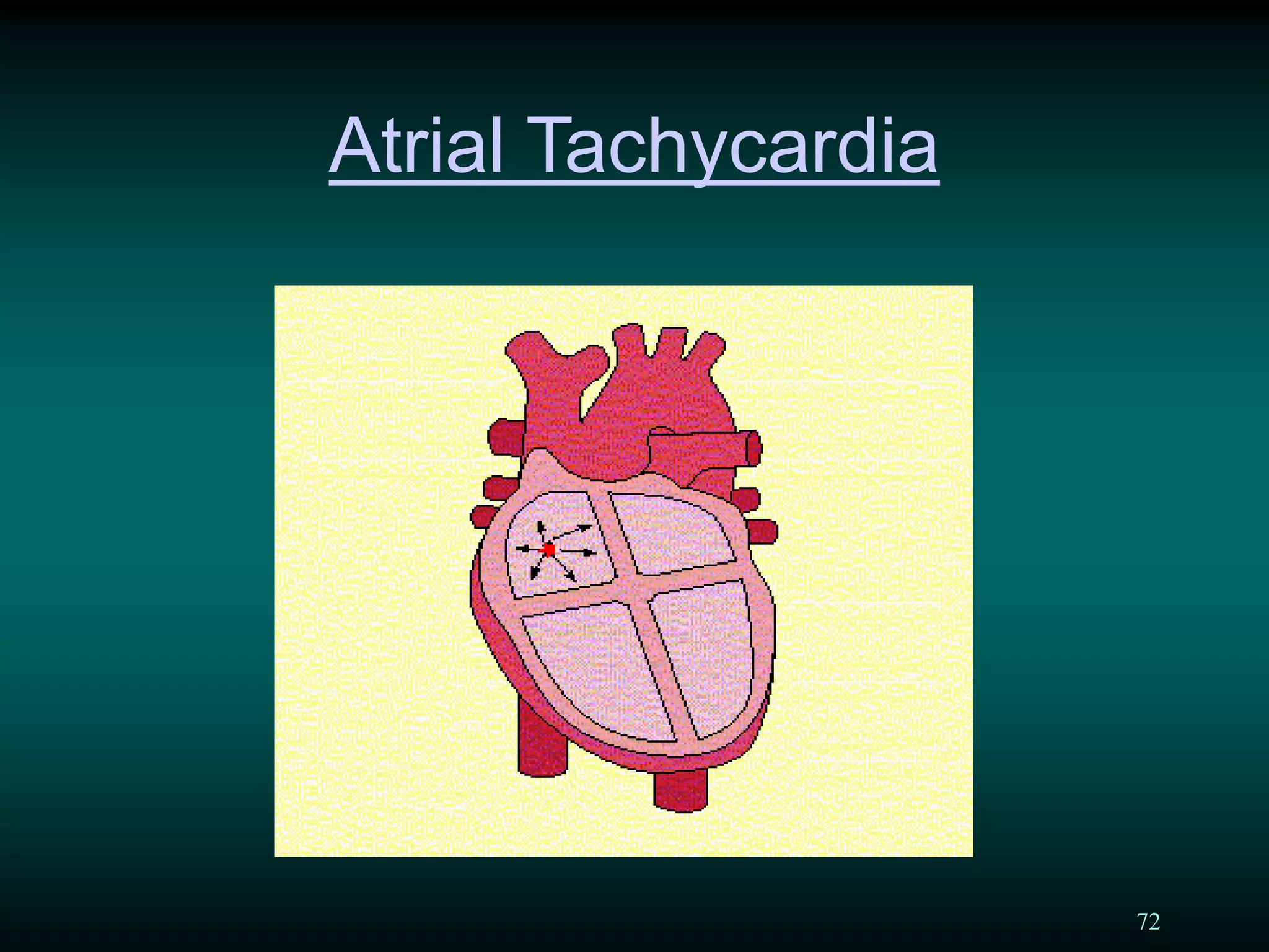 72
Atrial Tachycardia
 