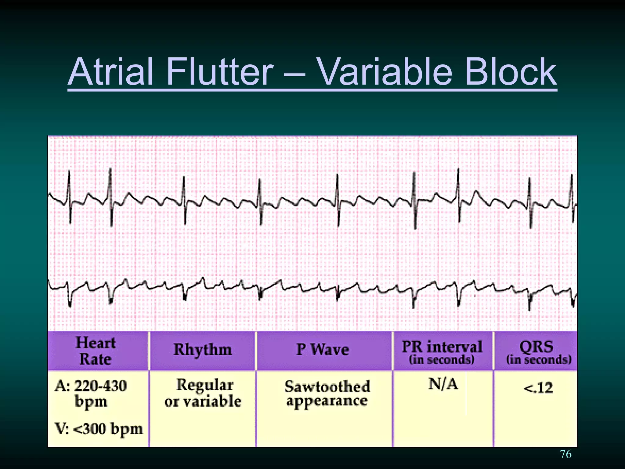 76
Atrial Flutter – Variable Block
 