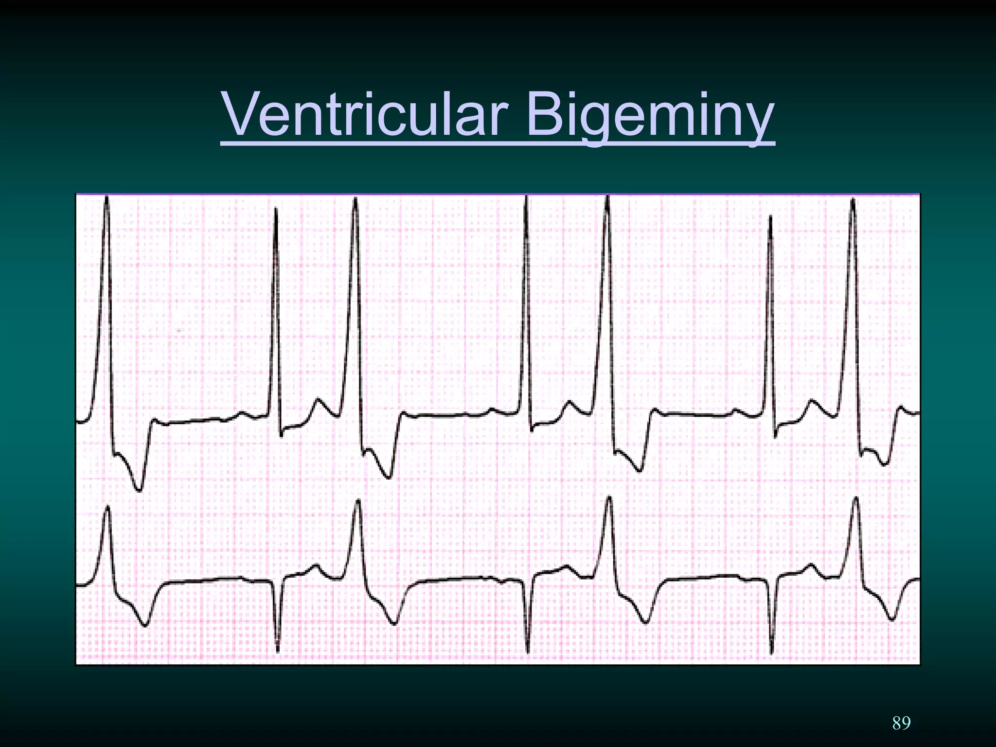 89
Ventricular Bigeminy
 