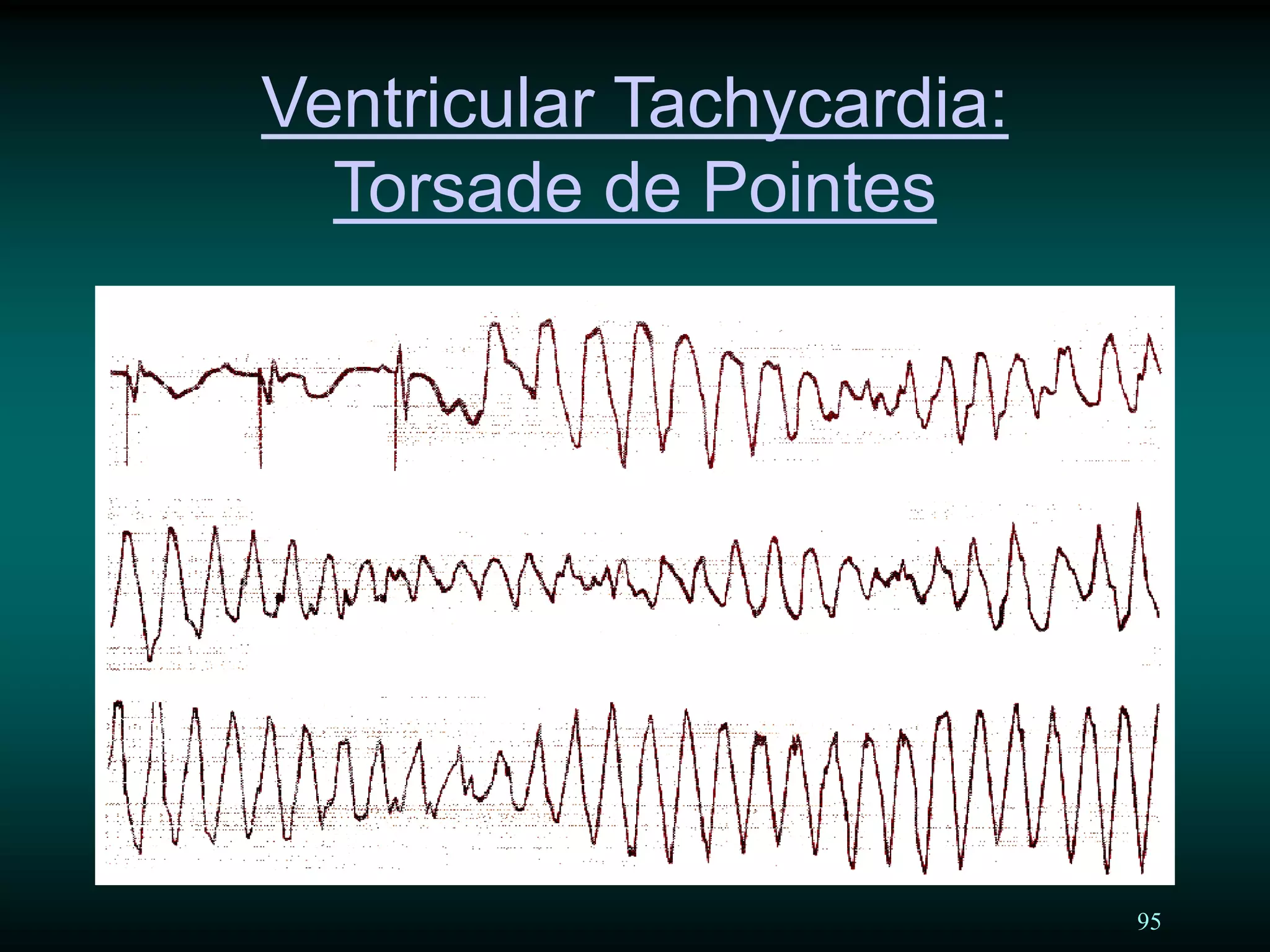 95
Ventricular Tachycardia:
Torsade de Pointes
 