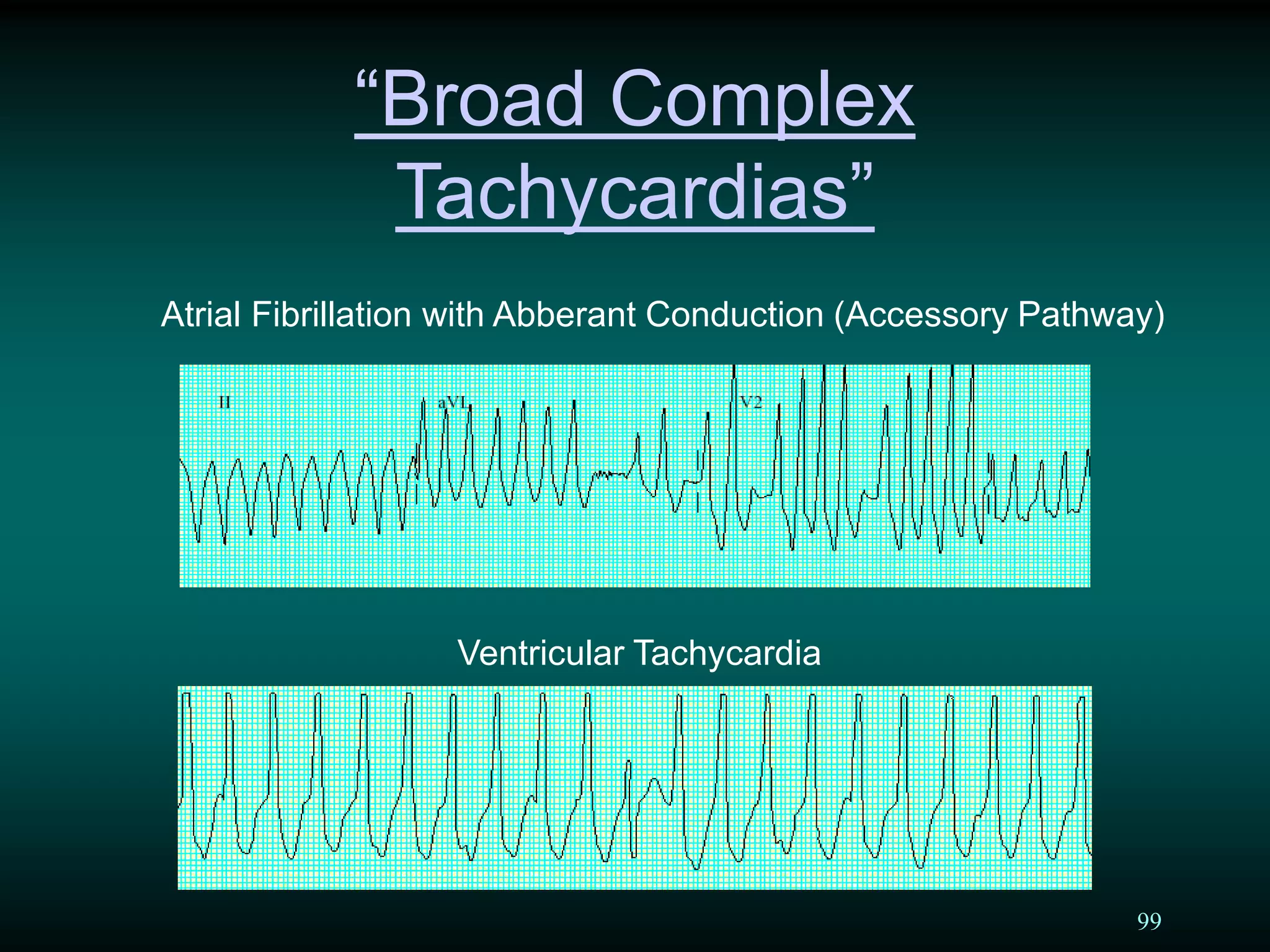 99
“Broad Complex
Tachycardias”
Atrial Fibrillation with Abberant Conduction (Accessory Pathway)
Ventricular Tachycardia
 