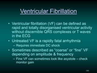 Vf Wave An overview of paediatric ECG | PDF