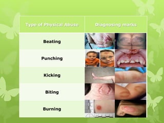 Type of Physical Abuse Diagnosing marks
Beating
Punching
Kicking
Biting
Burning
 