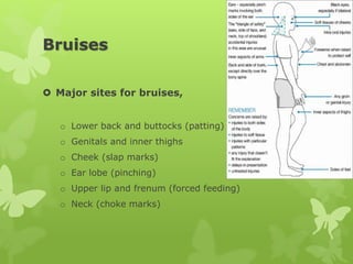 Bruises
 Major sites for bruises,
o Lower back and buttocks (patting)
o Genitals and inner thighs
o Cheek (slap marks)
o Ear lobe (pinching)
o Upper lip and frenum (forced feeding)
o Neck (choke marks)
 