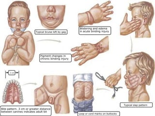 Typical bruise left by gag
Pigment changes in
chronic binding injury
Typical slap pattern
Loop or cord marks on buttocks
Blistering and edema
in acute binding injury
Bite pattern. 3 cm or greater distance
between canines indicates adult bit
3 cm
 
