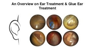 An Overview on Ear Treatment & Glue Ear
Treatment
 