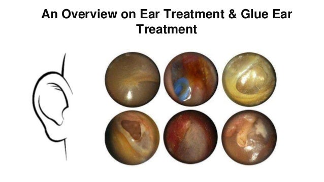 An Overview On Ear Treatment And Glue Ear Treatment