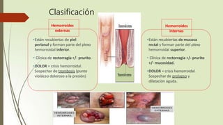Hemorroides
externas
•Están recubiertas de piel
perianal y forman parte del plexo
hemorroidal inferior.
• Clínica de rectorragia +/- prurito.
•DOLOR = crisis hemorroidal.
Sospechar de trombosis (punto
violáceo doloroso a la presión)
Hemorroides
internas
•Están recubiertas de mucosa
rectal y forman parte del plexo
hemorroidal superior.
• Clínica de rectorragia +/- prurito
+/- mucosidad.
•DOLOR = crisis hemorroidal.
Sospechar de prolapso y
dilatación aguda.
Clasificación
 