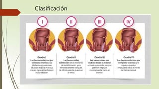 Clasificación
 