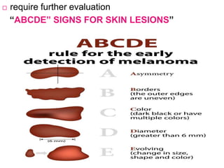  require further evaluation
“ABCDE” SIGNS FOR SKIN LESIONS”
 