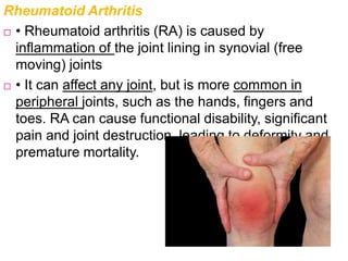 Rheumatoid Arthritis
 • Rheumatoid arthritis (RA) is caused by
inflammation of the joint lining in synovial (free
moving) joints
 • It can affect any joint, but is more common in
peripheral joints, such as the hands, fingers and
toes. RA can cause functional disability, significant
pain and joint destruction, leading to deformity and
premature mortality.
 
