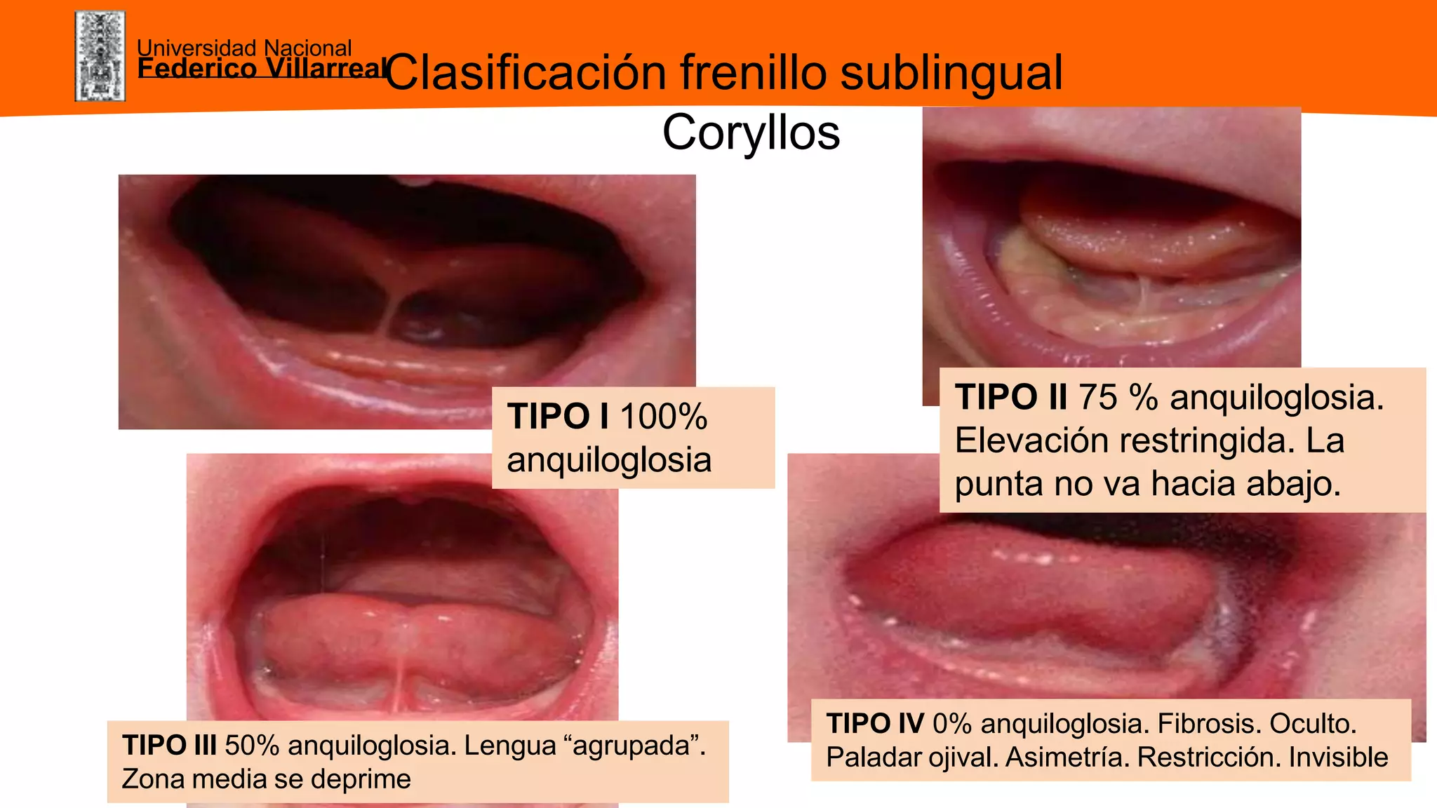 ANQUILOGLOSIA.pptx