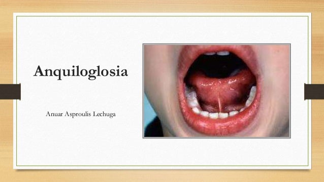 Anquiloglosia anuar