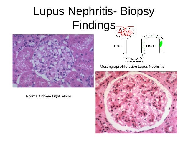 Dialysis and Transplant for Lupus Nephritis