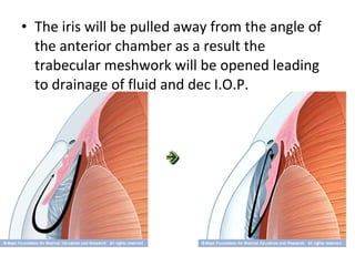 • The iris will be pulled away from the angle of
the anterior chamber as a result the
trabecular meshwork will be opened leading
to drainage of fluid and dec I.O.P.
 