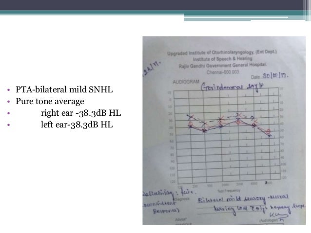 auditory neuropathy spectrum disorder in adults auditory neuropathy spectrum disorder in adults