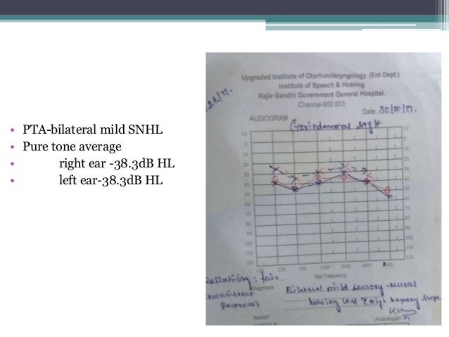 auditory neuropathy spectrum disorder in adults asha