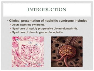 INTRODUCTION
• Clinical presentation of nephritic syndrome includes
• Acute nephritic syndrome,
• Syndrome of rapidly progressive glomerulonephritis,
• Syndrome of chronic glomerulonephritis
 