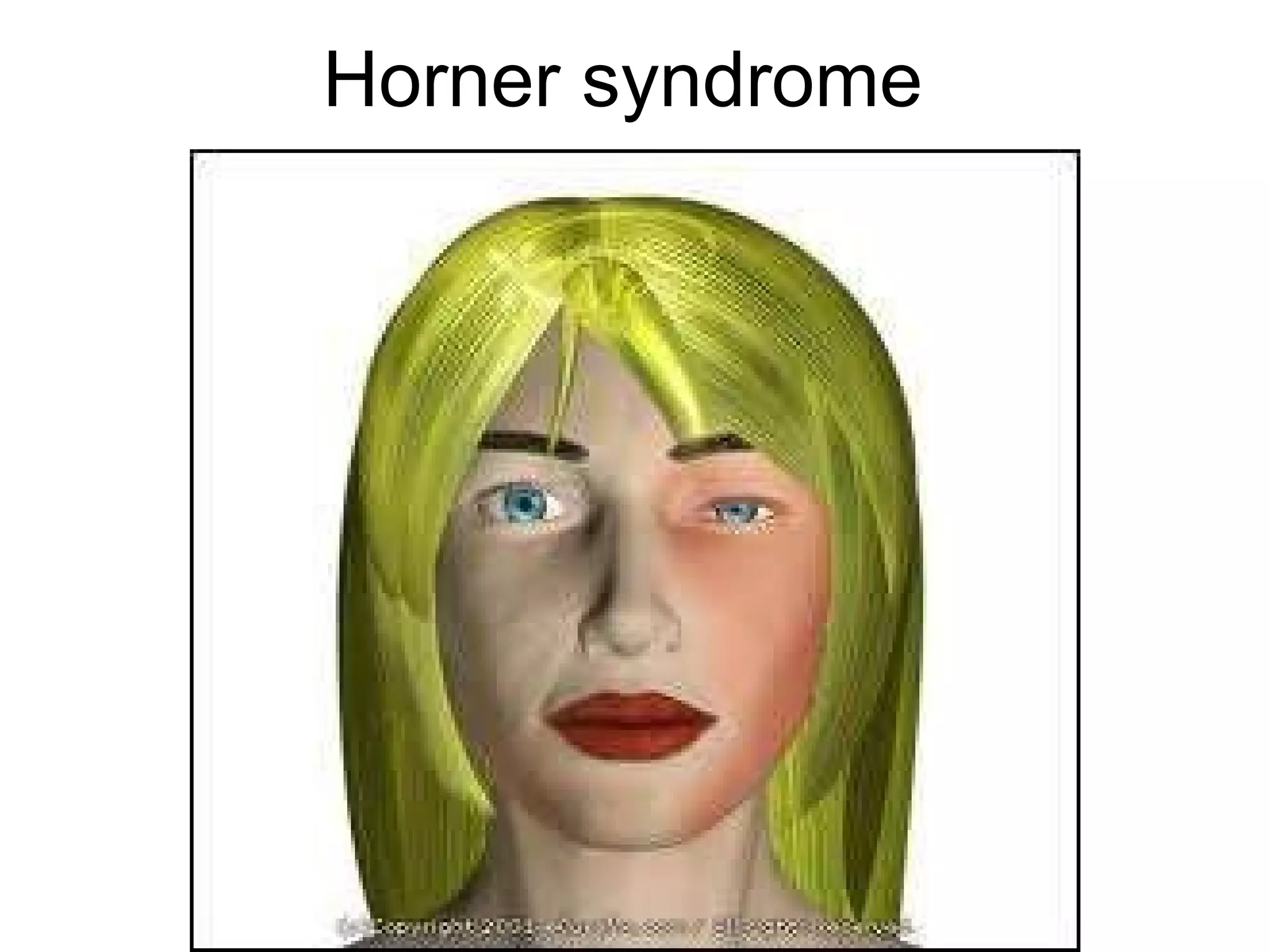 Horner syndrome 