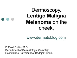 Dermoscopy. Lentigo Maligna Melanoma   on the cheek. F. Peral Rubio, M.D. Department of Dermatology  Complejo Hospitalario Universitario, Badajoz, Spain. www.dermatoblog.com  