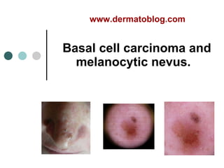   B asal cell carcinoma and melanocytic nevus.   www.dermatoblog.com   