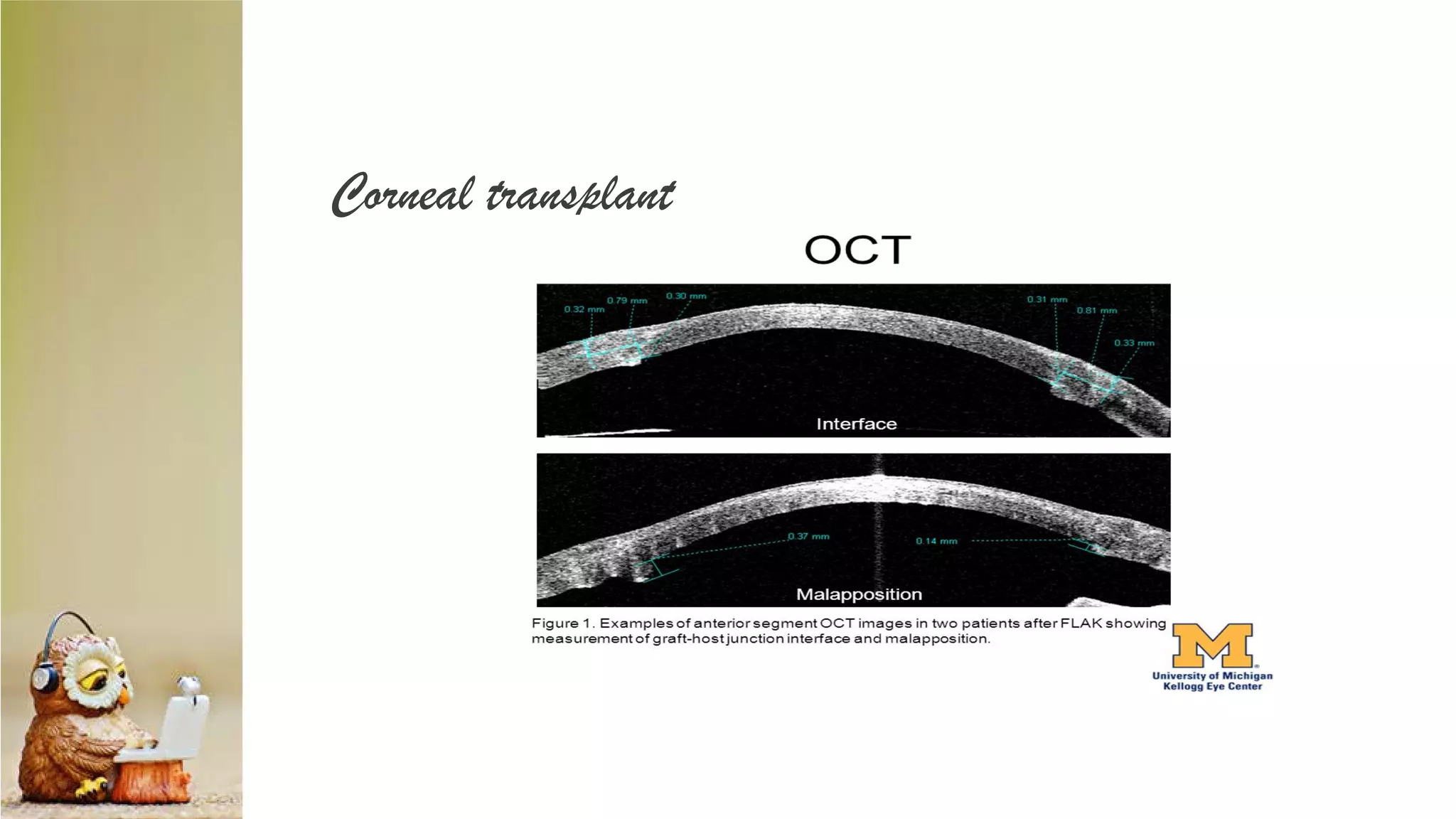 Corneal transplant