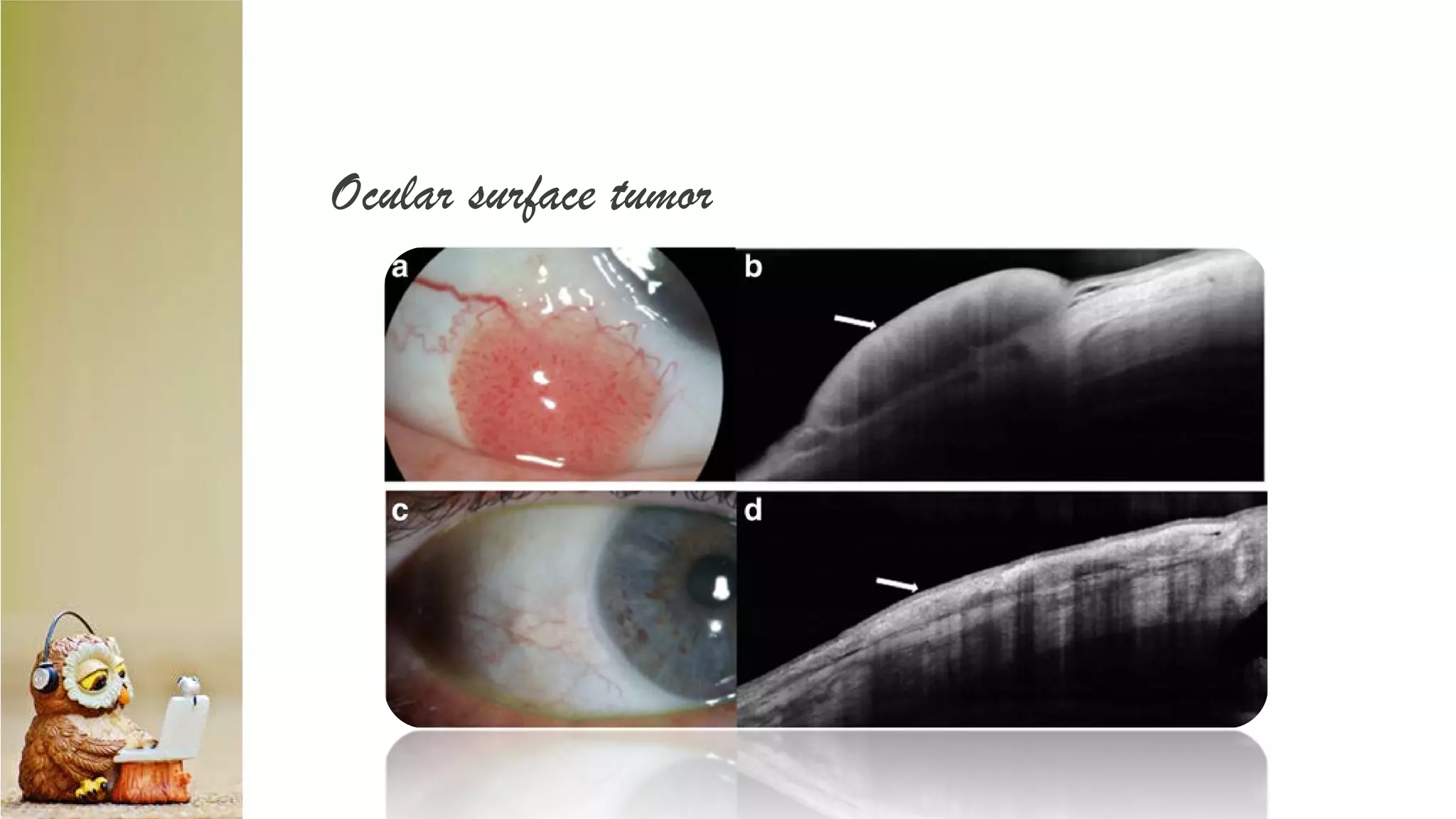 Ocular surface tumor