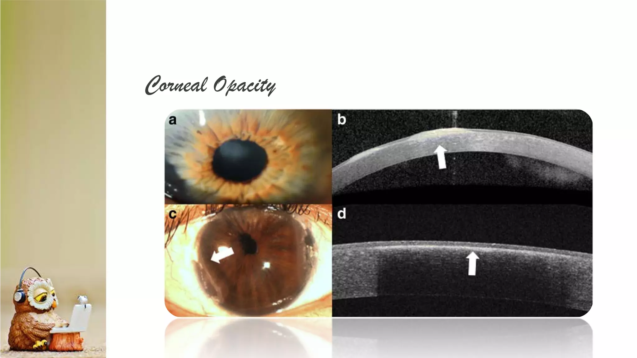 Corneal Opacity