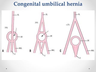 Umbilical Inverted Surgical Anatomy of anterior abdominal wall | PPTX