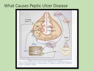 What Causes Peptic Ulcer Disease
 