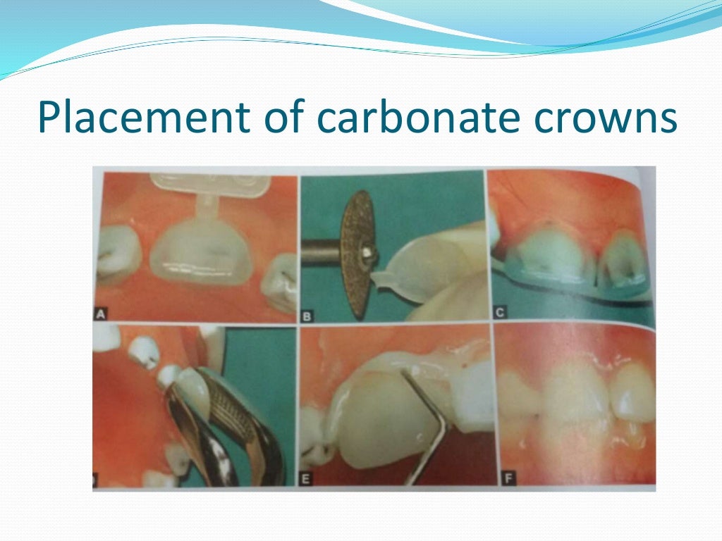 Stainless steel crowns in pediatric dentistry