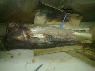 Fascia del
Antebrazo
 