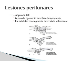  Lunopiramidal:
 Lesion del ligamento interóseo lunopiramidal
 Inestabilidad con segmento intercalado volarmente
Lesiones perilunares
 