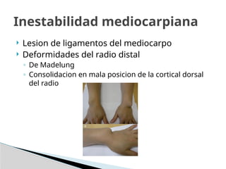  Lesion de ligamentos del mediocarpo
 Deformidades del radio distal
◦ De Madelung
◦ Consolidacion en mala posicion de la cortical dorsal
del radio
Inestabilidad mediocarpiana
 