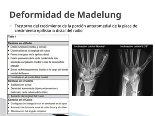  Trastorno del crecimiento de la porción anteromedial de la placa de
crecimiento epifisiaria distal del radio
Deformidad de Madelung
 
