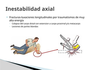  Fracturas-luxaciones longitudinales por traumatismos de muy
alta energía
◦ Colapso del carpo distal con extension a carpo proximal y/o metacarpo
◦ Lesiones de partes blandas
Inestabilidad axial
 